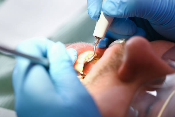 Best Emergency Dentist for Lost Fillings or Crowns in Dupo, IL